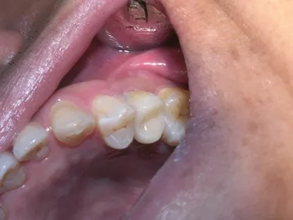 渥爾牙醫診所：小臼齒裂牙不拔牙，Cap-Lock全瓷修復保住原牙！