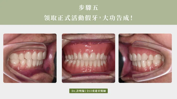 領取活動假牙 大功告成!