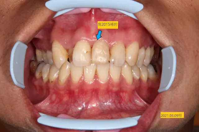 之前的補牙微滲漏染色，左上正中門牙才是我補的（箭頭所指），其他的，不是