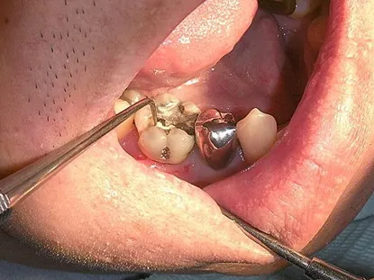 渥爾牙醫診所: Cap-Lock全瓷系列修復案例!斜裂下大臼齒的成功修復!