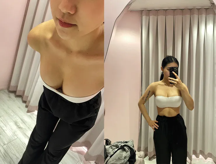 抽脂補胸 術後三個禮拜