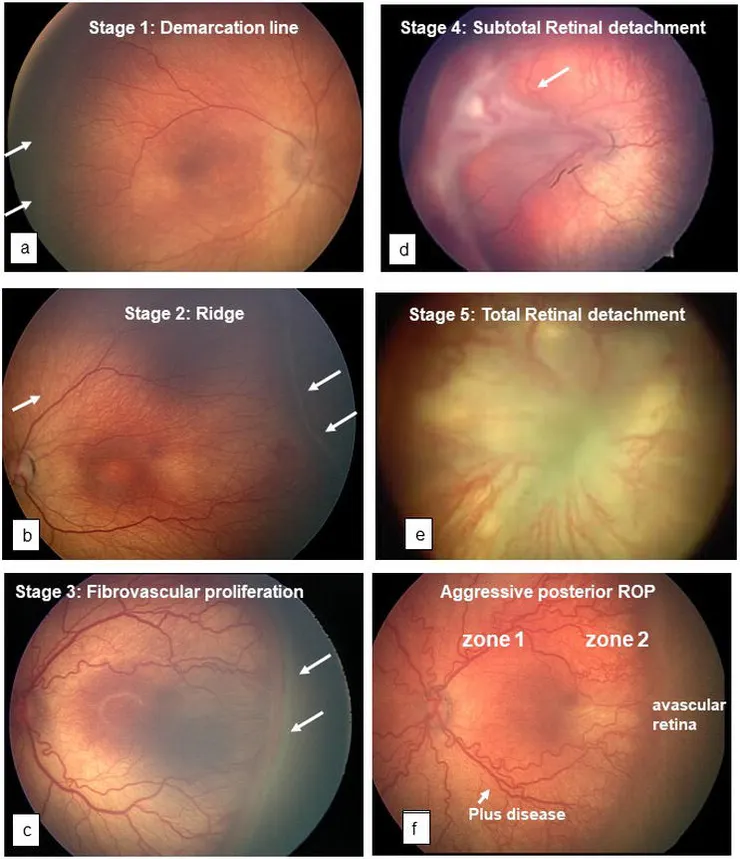 早產兒視網膜症 Retinopathy of Prematurity — CHAPTER METRICS OVERVIEW