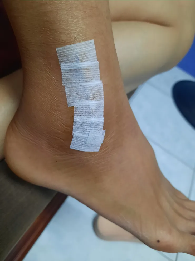 5／21自己換藥貼美容膠