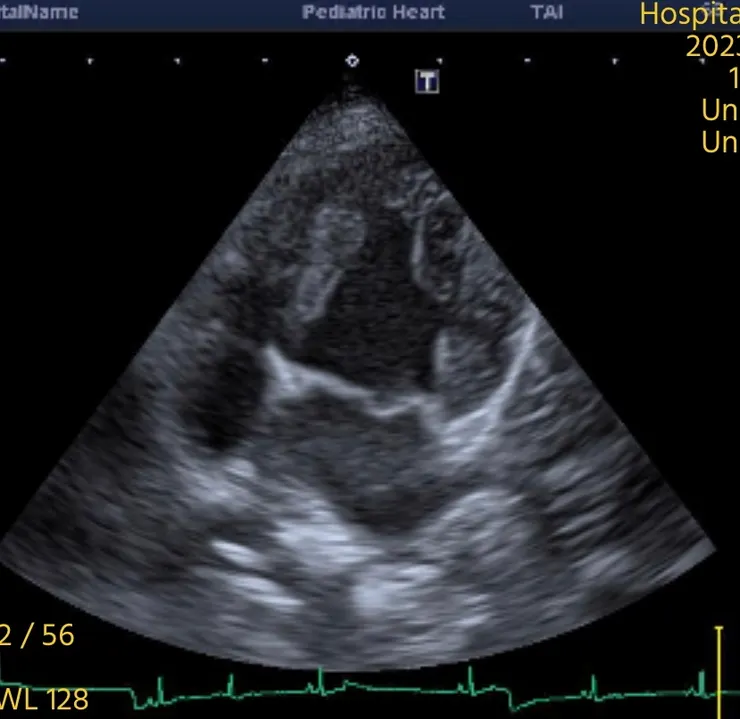 心臟超音波 二尖瓣退化