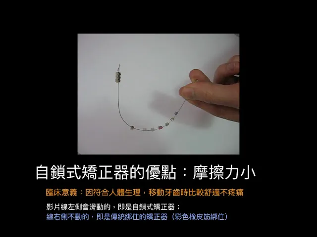 自鎖式矯正器摩擦力小的臨床優點