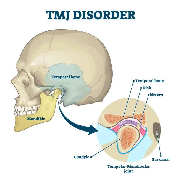 TMJ 顳顎關節 顳顎關節症候群 顳顎關節疼痛 顳顎關節失調