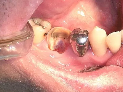 渥爾牙醫診所: Cap-Lock全瓷系列修復案例!斜裂下大臼齒的成功修復!