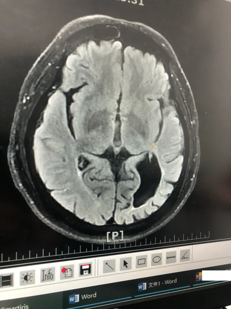 腦內缺了一大塊區域...看了挺嚇人的