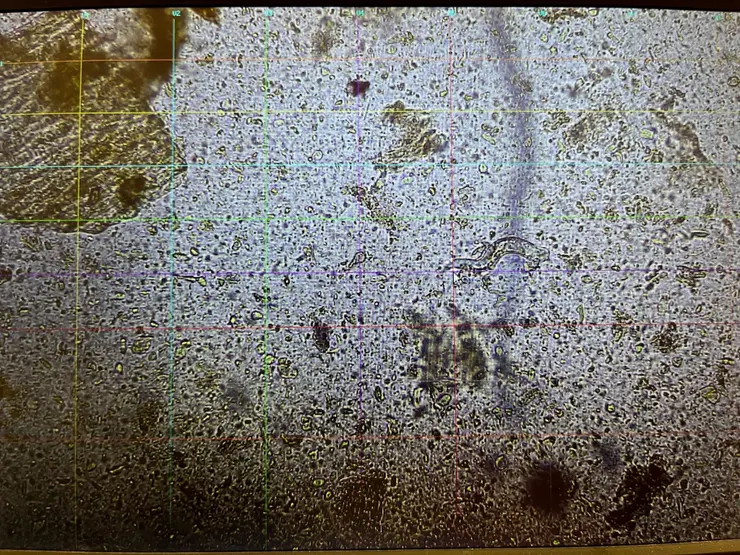 114/06/20寬麵糞檢發現寄生蟲