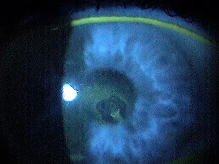 復發性角膜糜爛—Decision-Maker PLUS