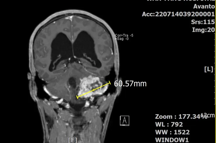椰當年在MRI下的龐大身軀(冠狀剖面)