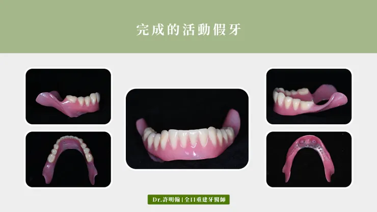 完成的鈕扣式活動假牙