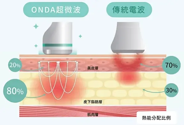 台北打雙下巴│ONDA超微波（昂達），台北醫美診所推薦【旭彤診所】