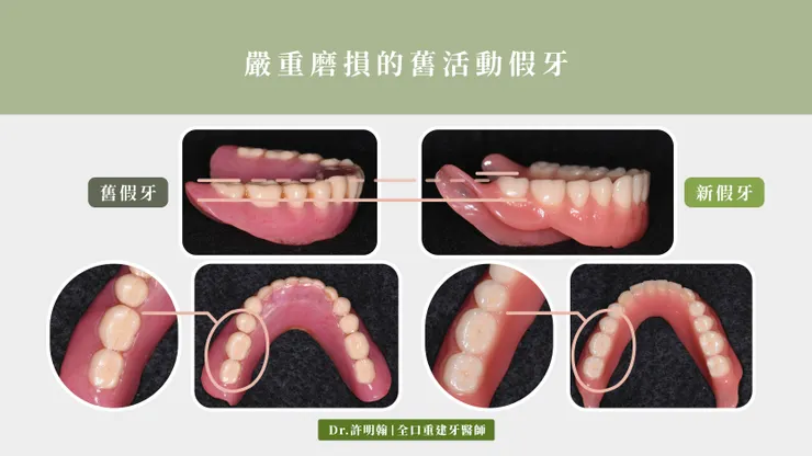 嚴重磨損的舊活動假牙