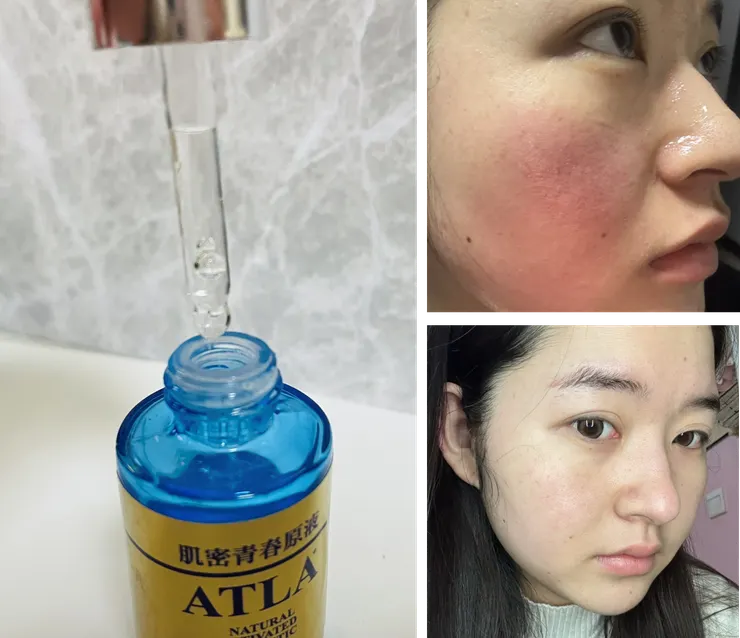 敏感肌精華液前後對比