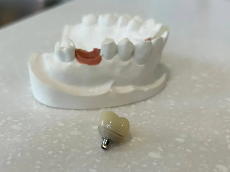 渥爾牙醫診所：植牙不只要穩，更要懂得「避震」！認識Bio-HPP新材料植體假牙