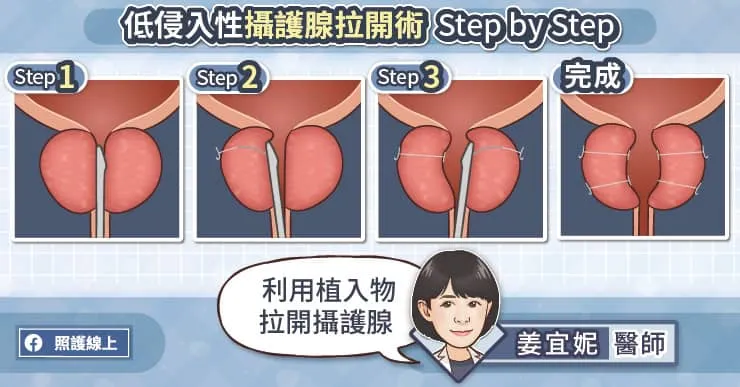 低侵入性攝護腺拉開術