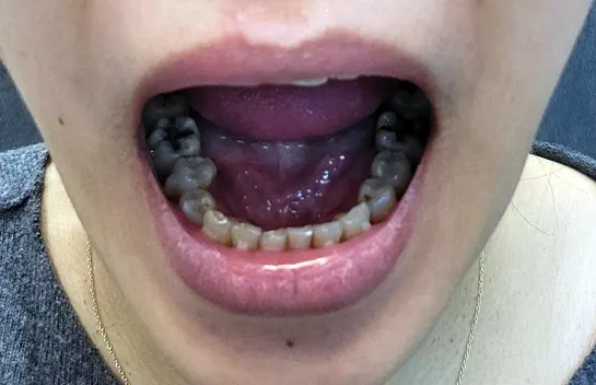 隱適美矯正紀錄 #除汞