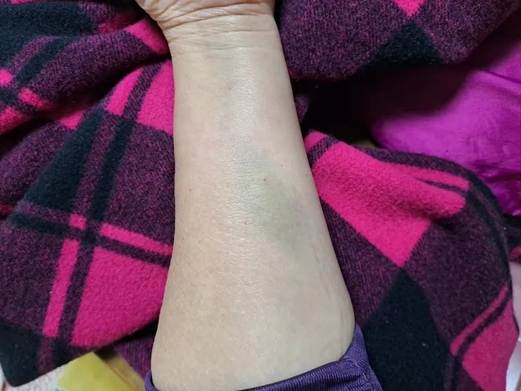 左手內側也傷痕累累