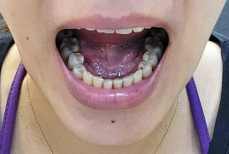 隱適美矯正紀錄 #除汞