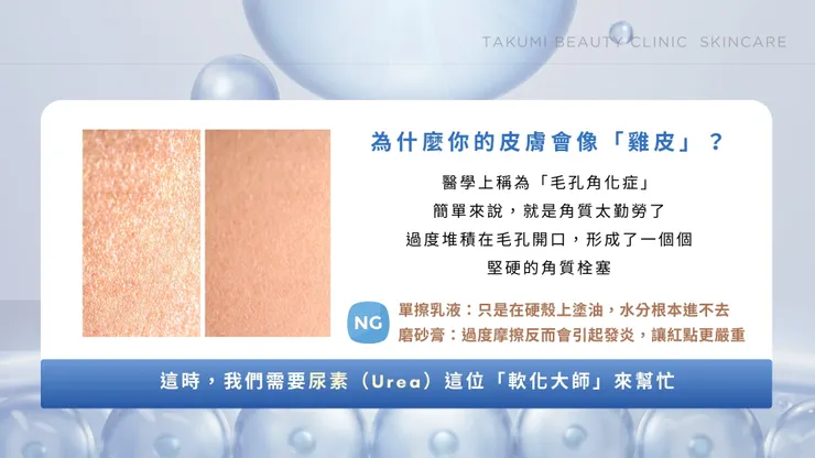 告別粗糙雞皮與乾裂！尿素乳膏搭配居家酸類換膚+醫美療程，找回消失已久的滑嫩感！