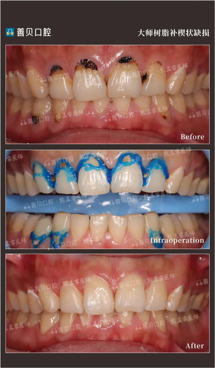 善貝口腔熊孟睿醫師補牙