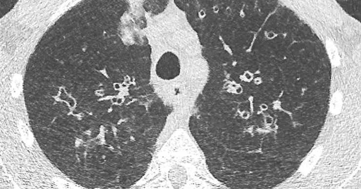 Ultra-low dose CT chest | Radiology SA