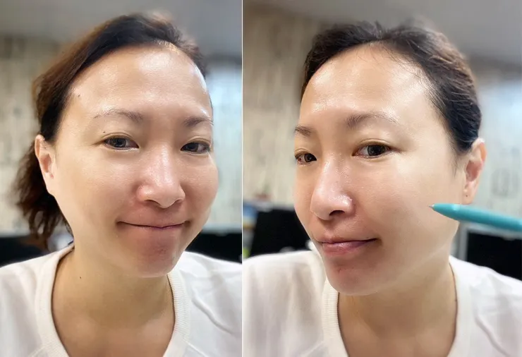 台北東區打雷射｜RedTouch PRO凍態雷射(果凍光)│台北打雷射推薦綻妍醫美診所