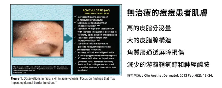 痘痘的起因曝光