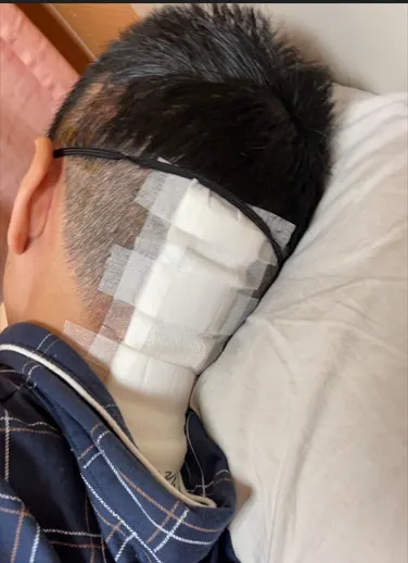 脊髓內室管膜瘤手術切除