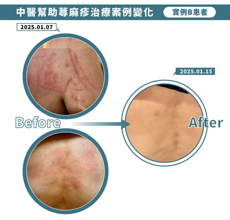 中醫幫助蕁麻疹治療案例變化-患者B