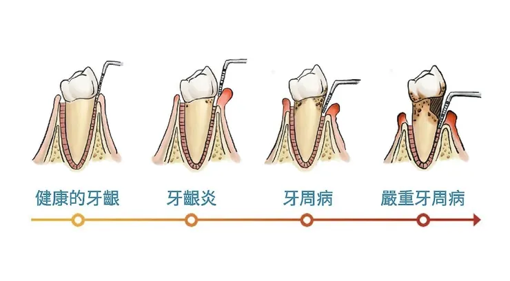 牙周病發展過程