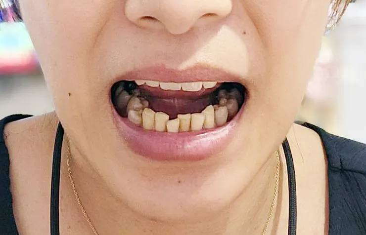 隱適美矯正紀錄 #除汞