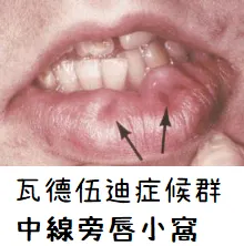 VWS中線旁唇小窩