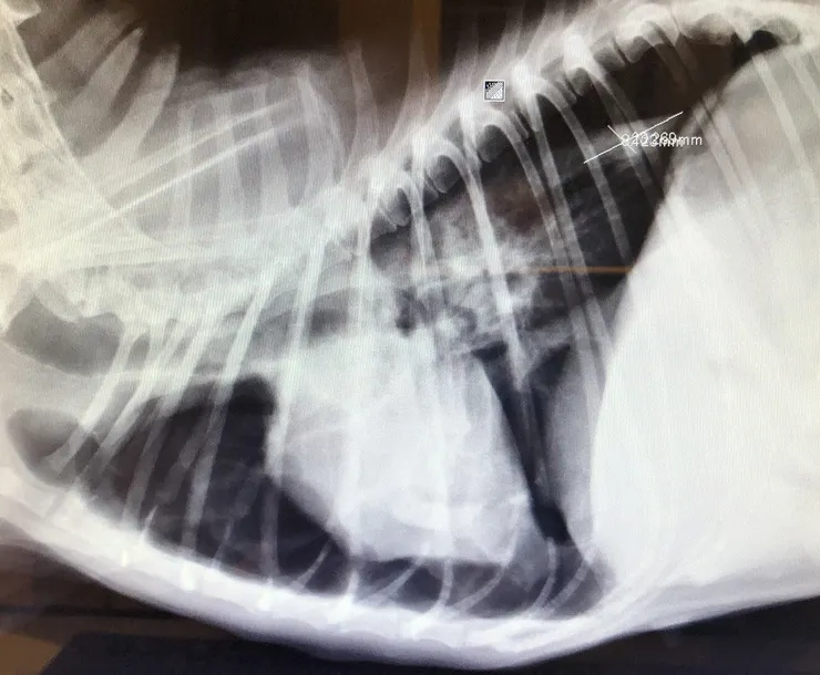 因大氣壓力遠高於肺內的壓力，硬物穿破食道後，每一次呼吸都會使空氣從破洞灌進胸膜腔裡(肺和胸壁的空間)，這時原本應充滿空氣的肺會被大氣壓力擠扁，就像皺縮的氣球一樣，而塌陷皺縮的肺是沒辦法進行氣體交換的