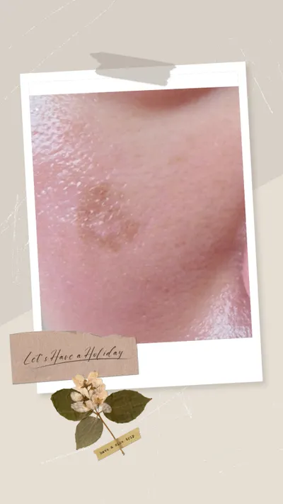 肌膚好轉反應天麗Joli保養品