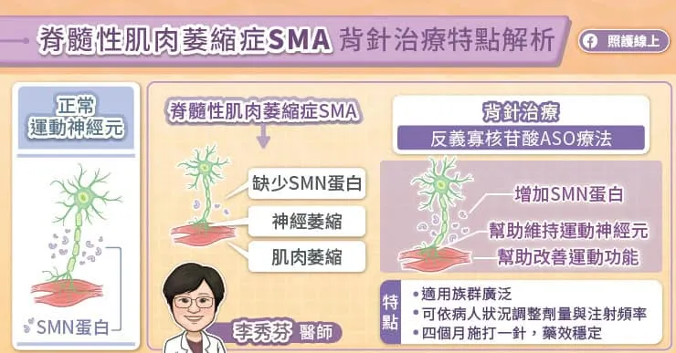 脊髓性肌肉萎縮症（SMA）背針治療