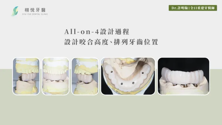 All-on-4設計過程：設計咬合高度、排列牙齒位置