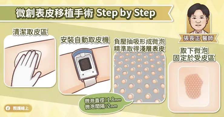 微創表皮移植手術是運用水泡取皮的原理