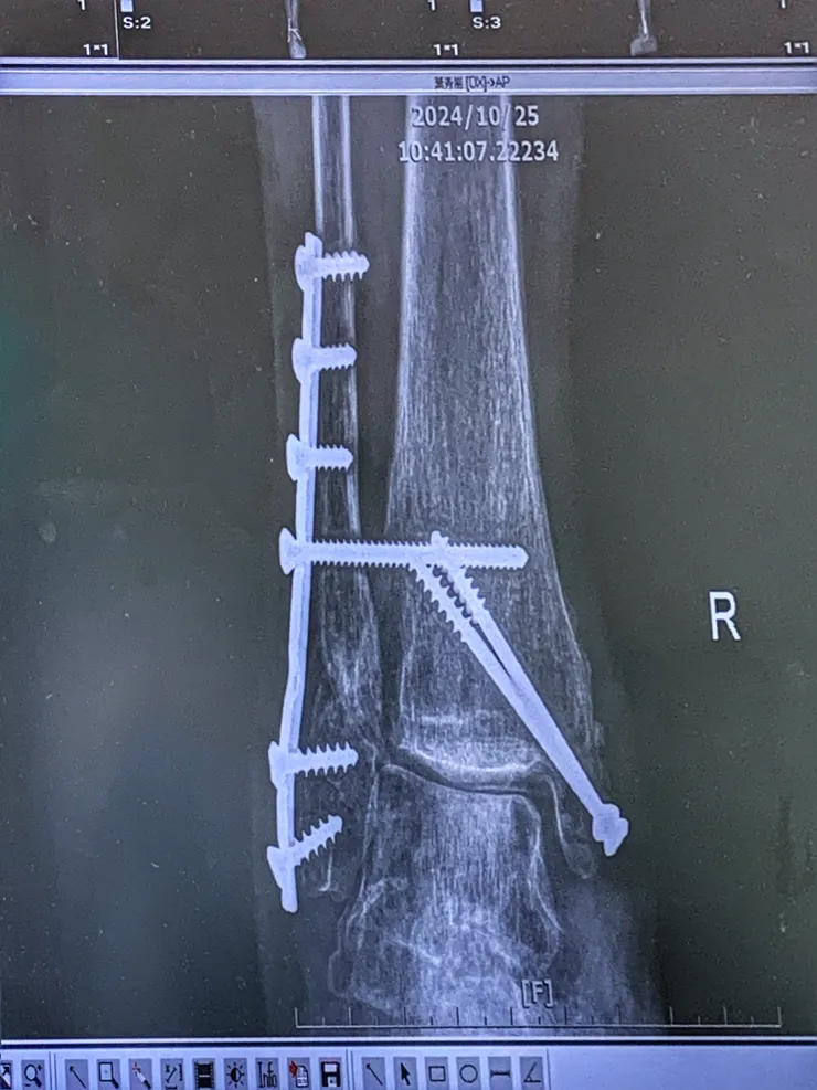 今天取出橫向的鋼釘