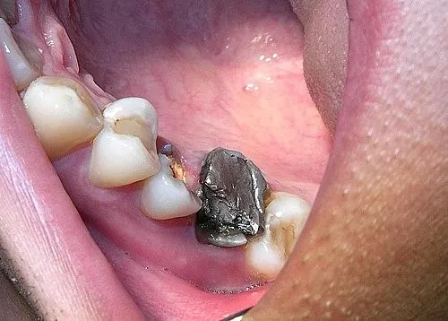 渥爾牙醫診所:斜裂小臼齒修復案例!Cap-Lock全瓷系列的完美應用(案例一)