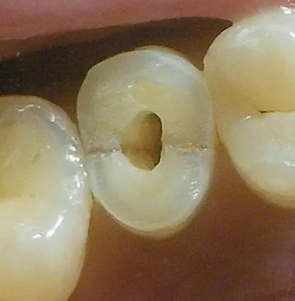 渥爾牙醫診所：小臼齒裂牙不拔牙，Cap-Lock全瓷修復保住原牙！