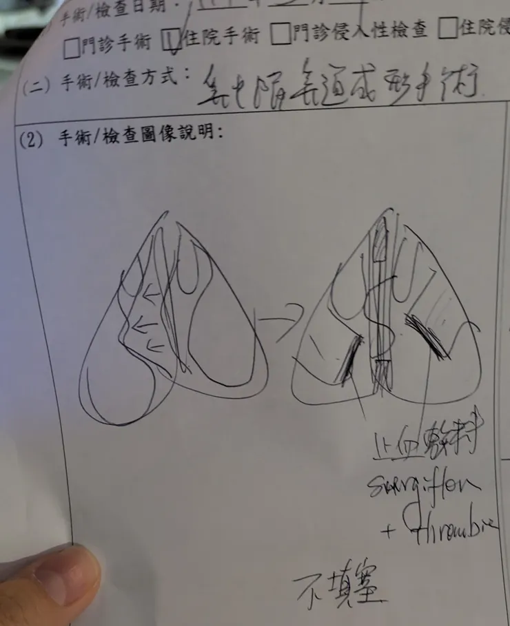 鼻中隔手術方案