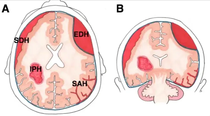 顱內出血類型（A）軸向視圖和（B）冠狀視圖；EDH = 硬腦膜外血腫、SDH = 硬腦膜下血腫、SAH = 蜘蛛膜下腔出血、IPH = 實質內出血 (來源：TeachMe)