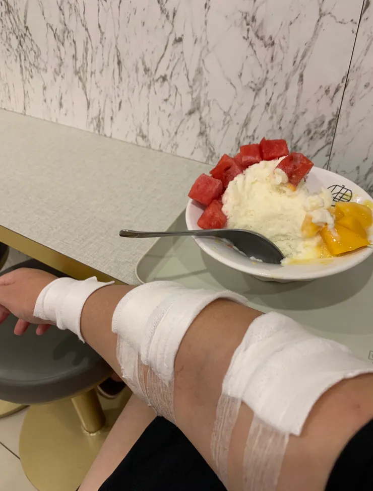 找不到特別拍錯誤的包紮照，只找到當時燙傷後覺得需要心靈慰藉跑去吃冰，順便拍給朋友看討拍的照片）