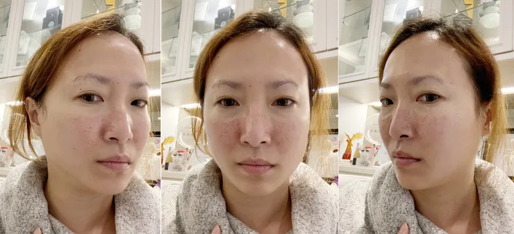 台北打皮秒│探索皮秒+蜂巢(超級鏡片ReFIX)-台北醫美診所推薦