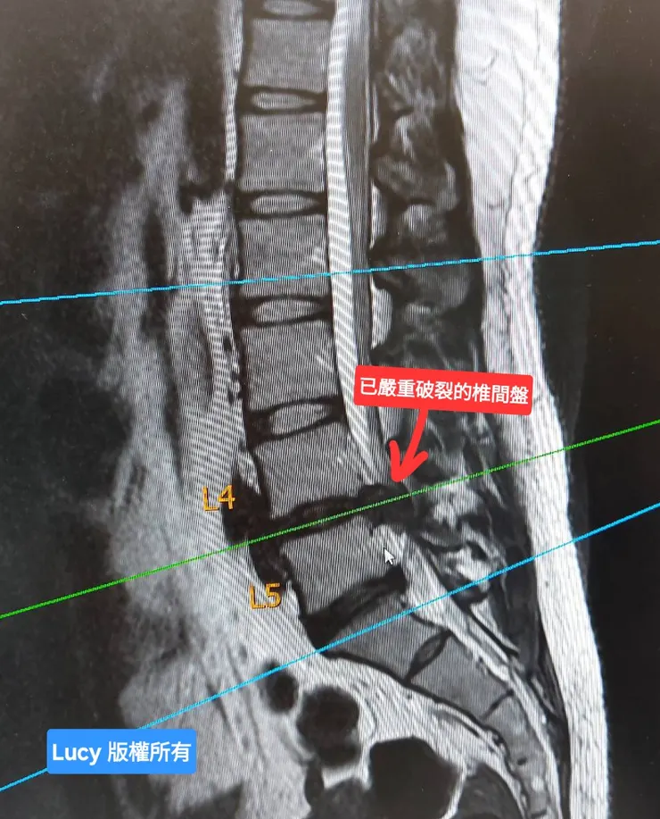 核磁共振影像看到第4、5節椎間盤嚴重破裂