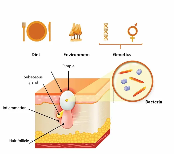痘痘形成因素(圖源 QMA Life Science)