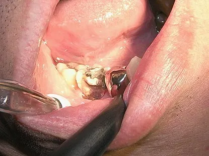 渥爾牙醫診所: Cap-Lock全瓷系列修復案例!斜裂下大臼齒的成功修復!