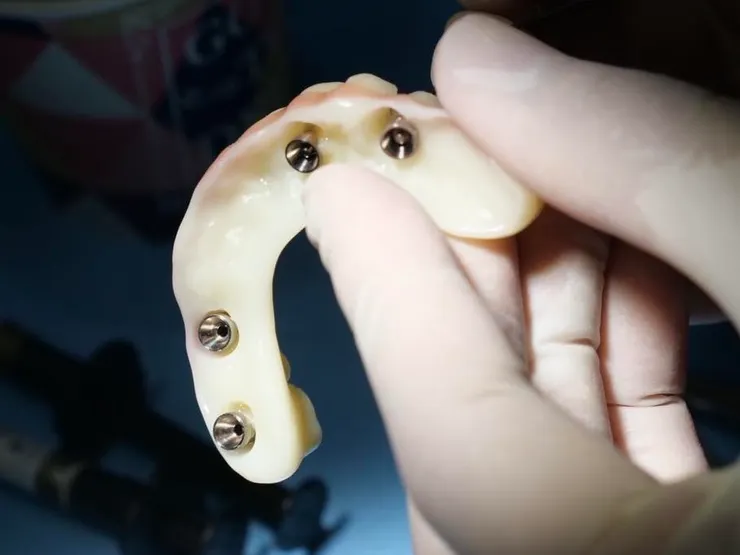 渥爾牙醫診所：All-on-4 全口重建個案成果報告！重新找回自信笑容的一天！